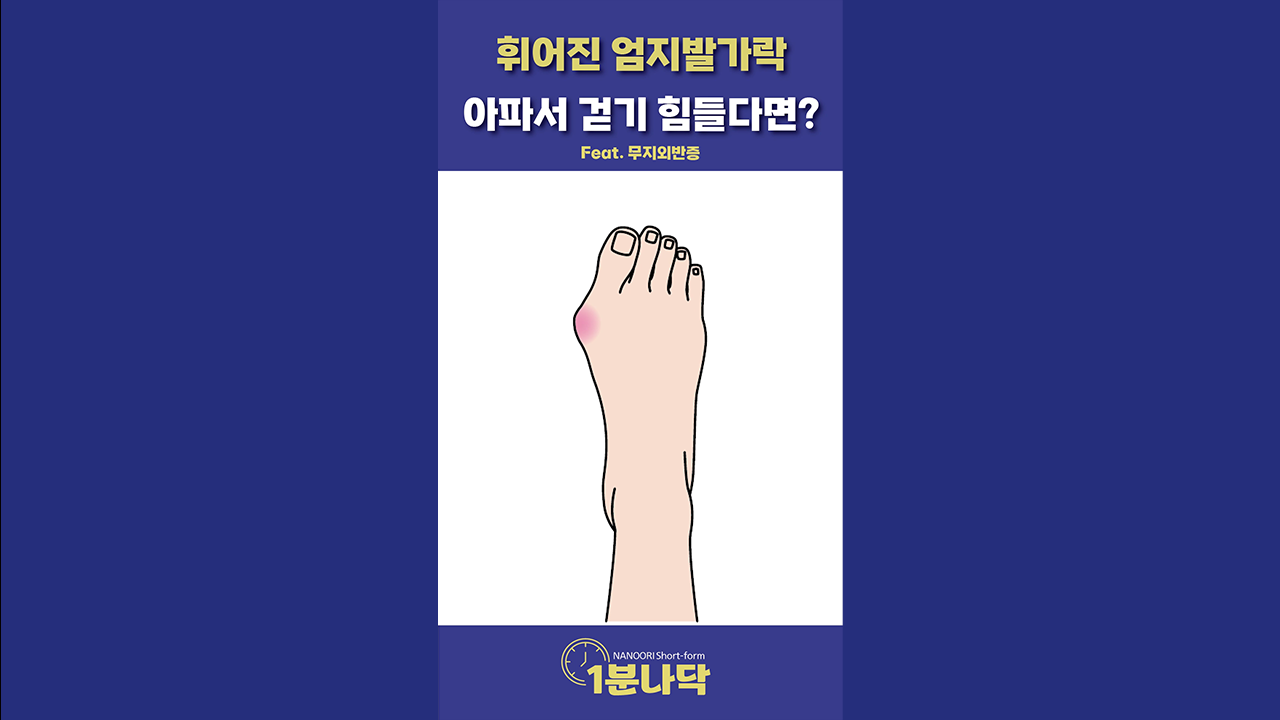 [1분나닥] 휘어진 엄지발가락, 아파서 걷기 힘들다면? (Feat. 무지외반증)