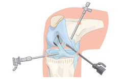 Percutaneous Endoscopic Lumbar Discectomy Img